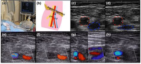 Ultrasound-guided identification of the femoral vein. a Preparation of... | Download Scientific ...