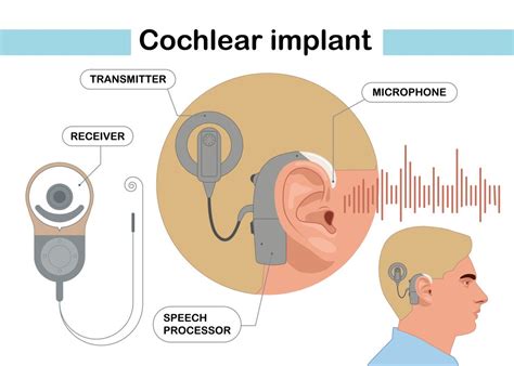 Cochlear Implant Surgery: A Comprehensive Guide