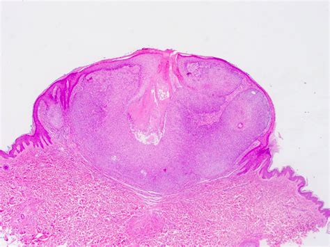 Pathology Outlines - Trichilemmoma