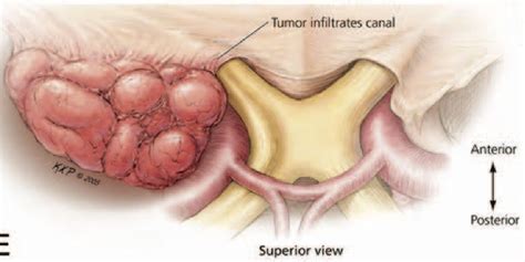 Modern surgical outcomes following surgery for sphenoid wing meningiomas | Neurosurgery Blog