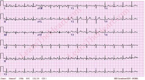 Hypokalemia Ecg