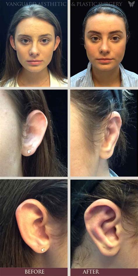 Ear Reconstruction Surgery In Ft Lauderdale FL | Vanguard Aesthetic ...