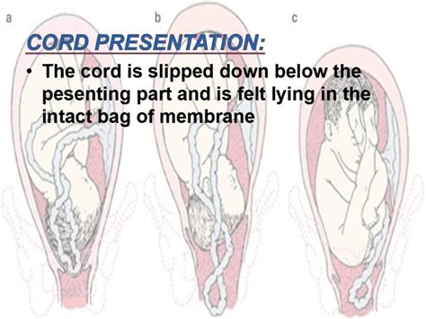 Cord prolapse