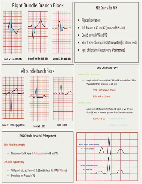 Right Ventricular Hypertrophy Rvh Ecg Criteria Clinic - vrogue.co