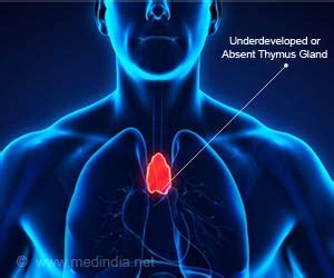 DiGeorge Syndrome - Causes, Symptoms, Diagnosis, Treatment & Prognosis