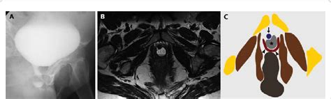 A) Voiding cystourethrography, oblique view B) MRI axial T2 weighted... | Download Scientific ...