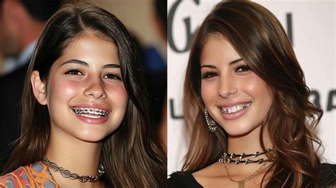 Braces Before and After Celebrities - Slink Ph