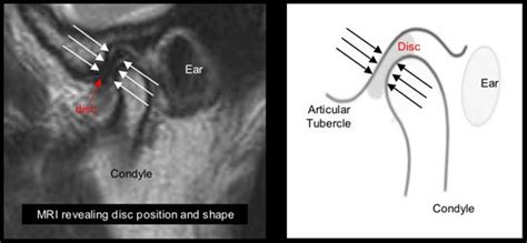 An Introduction To TMJ - Schur Orthodontics