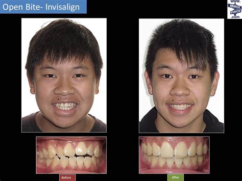 Invisalign® Before & After | Freehold Hightstown Manalapan NJ