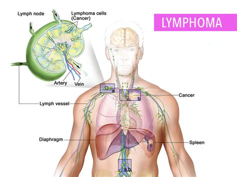 Overview of Non Hodgkins Lymphoma - CancerConnect