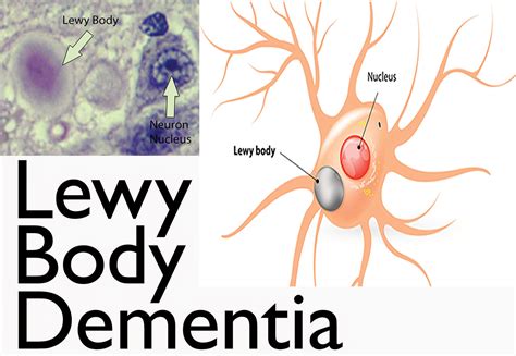 What is Lewy Body Dementia - Causes, Symptoms, Diagnosis, Treatments