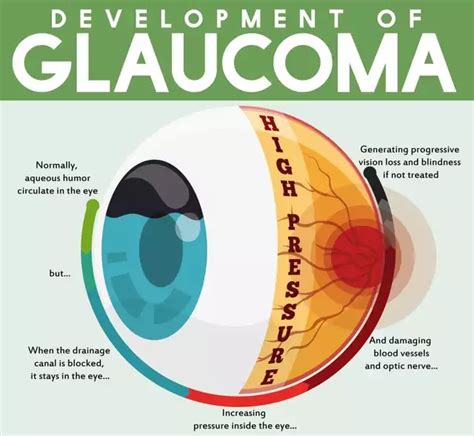 Glaucoma and Blindness - The Glaucoma Community - Responsum Health