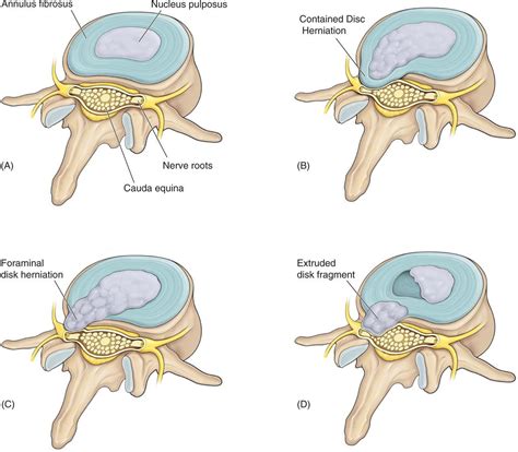 Percutaneous Disc Decompressions | Anesthesia Key