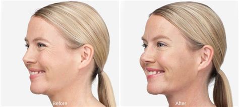 Botox Before and After | Westport, CT - New Beauty Wellness