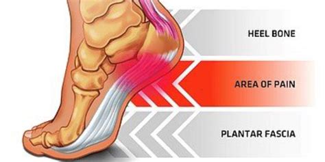 Plantar Fasciosis: How to tell, tips and home remedies | Baron Active