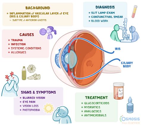 Iridocyclitis: What Is It, Causes, Diagnosis | Osmosis