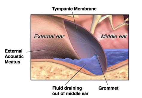 Consent: Insertion of Grommets - TeachMeSurgery