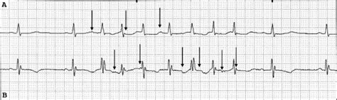 Atrial Ectopic Tachycardia in a Patient With Marfan Syndrome | Ochsner Journal