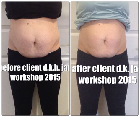 All New Before and After Pictures – Healing the Diastasis Recti 2015 ...