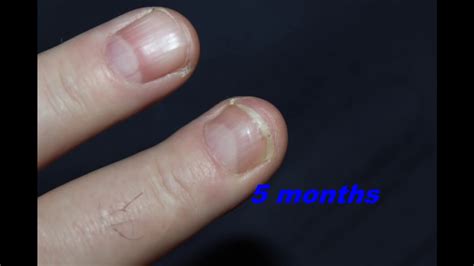 Finger Injury Time-Lapse Six Months in 2 Minutes - YouTube