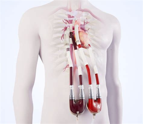 New circulation implant to bridge the waiting time for donor heart • healthcare-in-europe.com