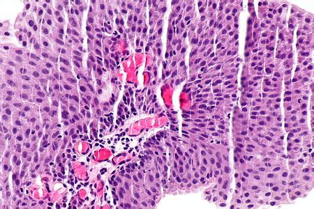 Low-grade papillary urothelial carcinoma - Libre Pathology