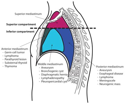 Anatomy, Thorax, Mediastinum - StatPearls - NCBI Bookshelf