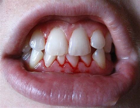 Tips to Prevent and Cope With Bleeding Gums | Healthy Logica