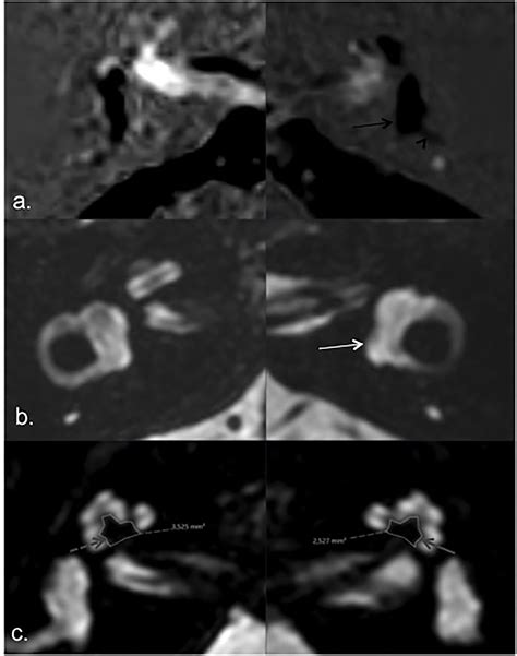 Frontiers | MR Imaging of Cochlear Modiolus and Endolymphatic Hydrops ...