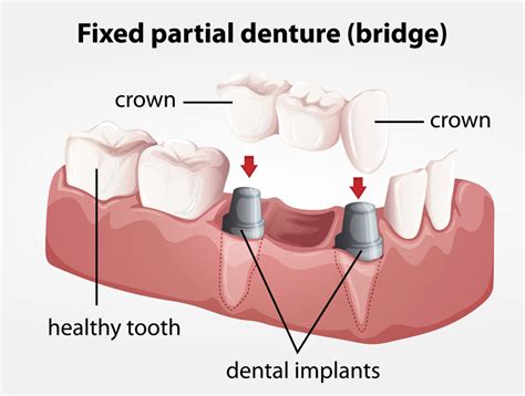 Dental bridge cost break down, procedure and problems - Los Angeles, CA