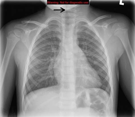 Croup (Laryngotracheitis) - Stepwards