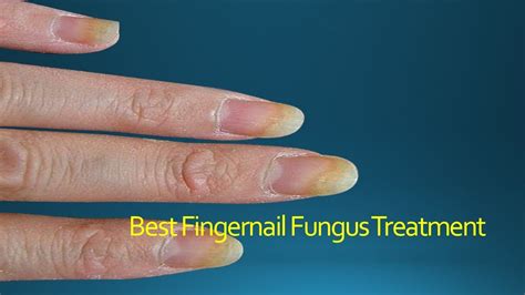 Best Fingernail Fungus Treatment - YouTube