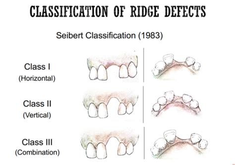 Ridge Preservation and Ridge Augmentation Flashcards | Quizlet