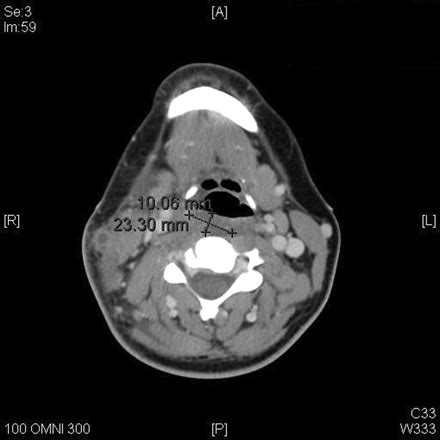 Lemierre's Syndrome - microbewiki