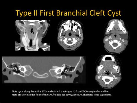 Branchial Cleft Cyst Ultrasound