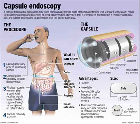 Capsule Endoscopy In Beverly Hills, Los Angeles - My Concierge MD