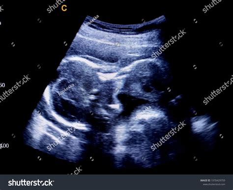 Nuchal Fold By Ultrasound Scar Stock Photo 1970429759 | Shutterstock