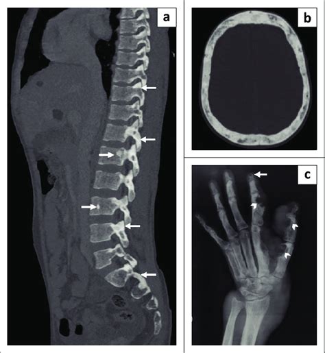 Bone manifestations of tuberous sclerosis complex. Reformatted sagittal ...