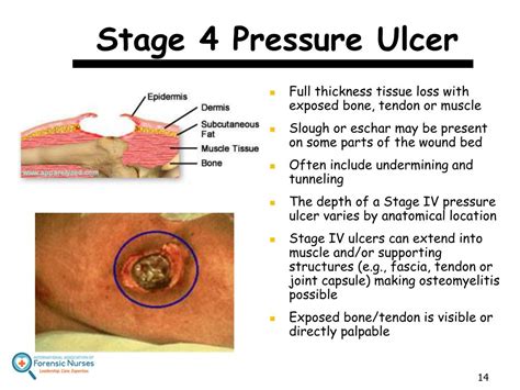 Stage 1 Pressure Ulcer Sacrum