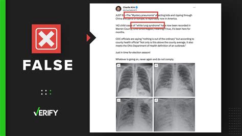 There isn't a 'mystery' pneumonia called ‘white lung syndrome’ | verifythis.com