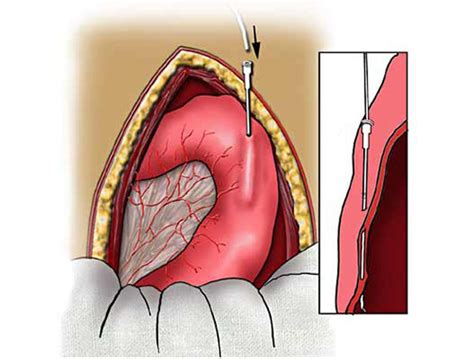 Jejunostomy