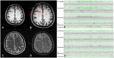 Frontiers | Utility of hybrid PET/MRI in stereoelectroencephalography guided radiofrequency ...