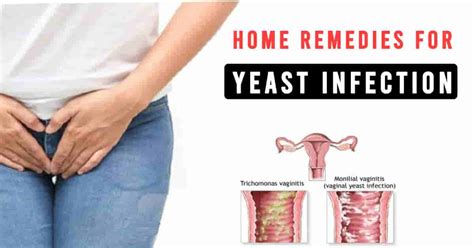 10 Easy Home Remedies for Yeast Infection | HealthtoStyle