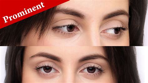 How to immediately know if your eyes are PROMINENT or PROTRUDING? - YouTube