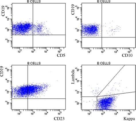 Concurrent CD5-negative small lymphocytic lymphoma (SLL) and CD5 ...