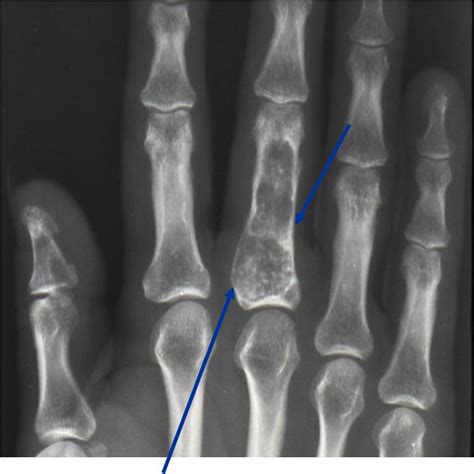 Enchondroma : Benign Bone Tumor: Tumors of Bone