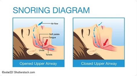 Types and Causes of Snoring