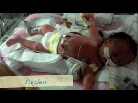 Gastroschisis Awareness Day 2012 - YouTube