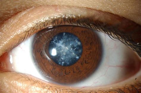 Blue Dot Cataract - Everything You Need To Know