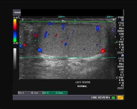 Ultrasound and Color Doppler videos: Focal epididymitis: